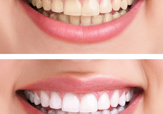 Flexible financing and our in-house savings plan can help lower the cost of your professional whitening treatment