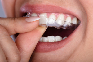 Close-up of woman placing clear aligner over teeth